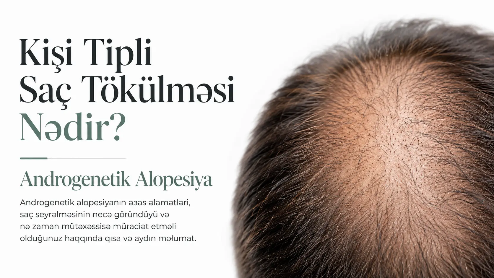 Kişi Tipli Saç Tökülməsi Nədir? Androgenetik Alopesiya