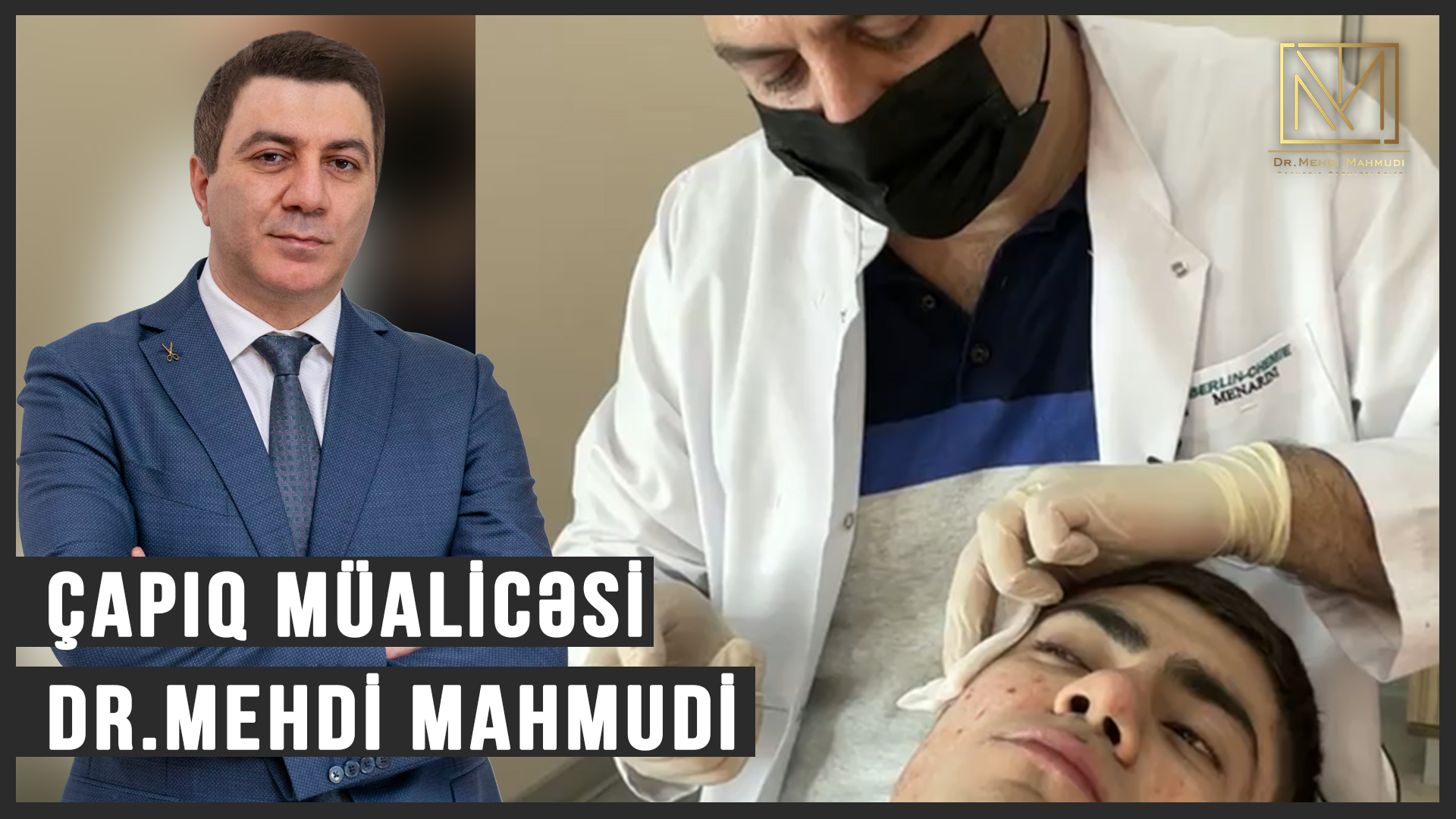 Canlı yayında capıq mualicesi / Üzdəki Çapıq Müalicəsi / Dr Mehdi