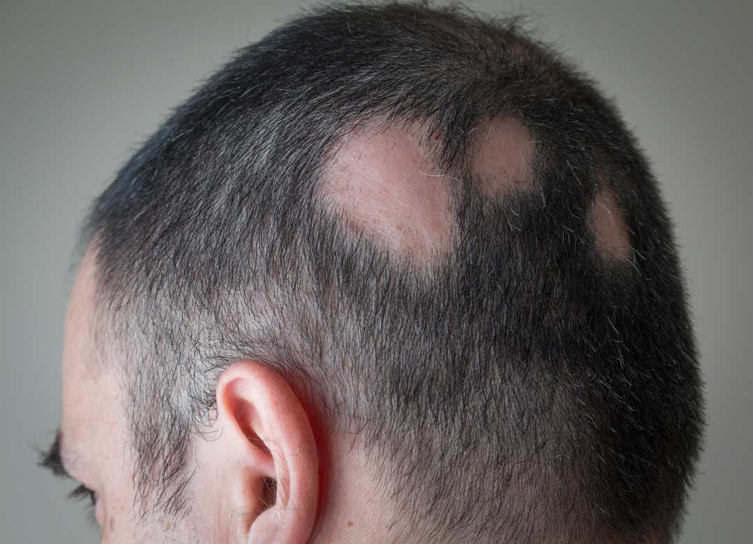 Ocaqlı saçtökülmə (ocaqlı dazlıq) nədir? Müalicəsi necədir? Alopesiya areata