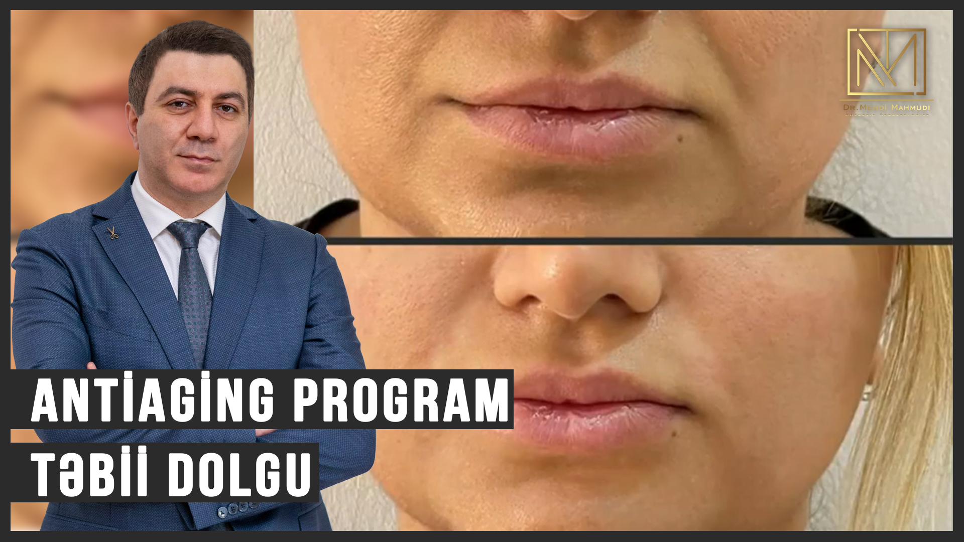 Antiaging Program / Təbii Dolgu / Dr Mehdi