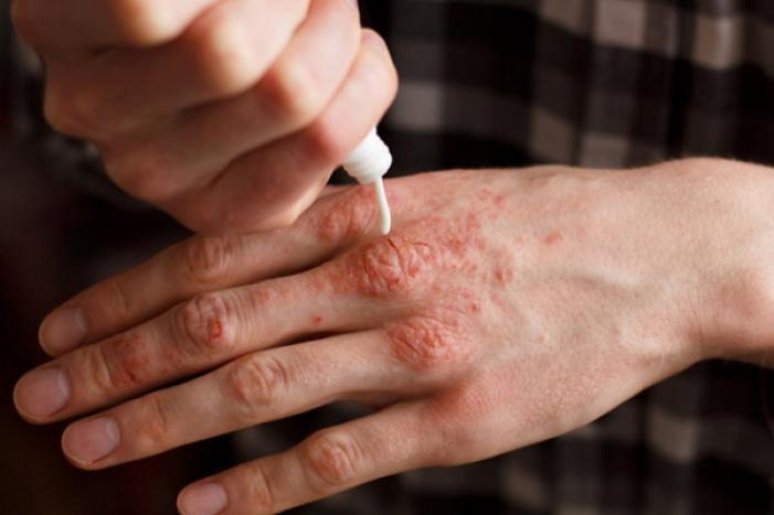 Psoriaz nədir? Müalicəsi necədir? Dermatoloq Dr Mehdi