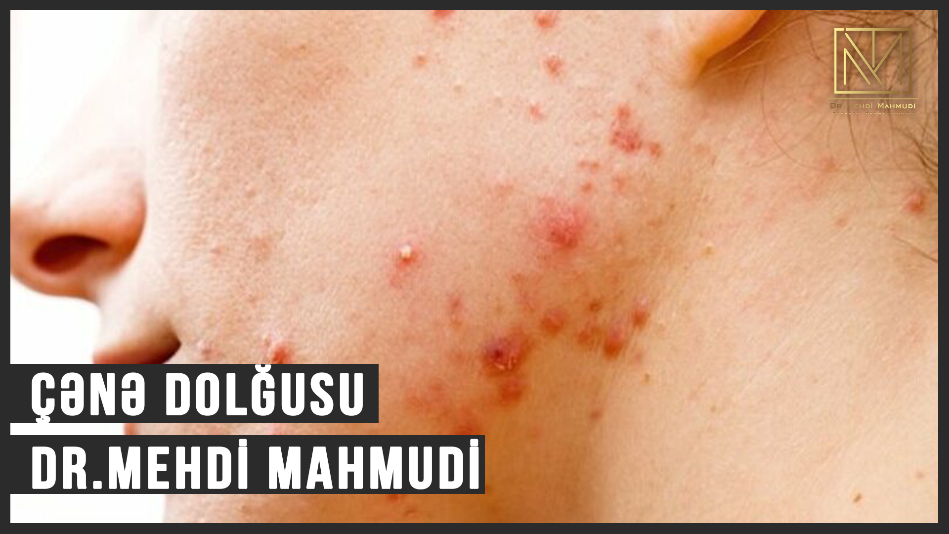 Sızanaq (Akne) Müalicəsinin Nəticəsi - Dermatoloq Dr.Mehdi Mahmudi #dermatoloq