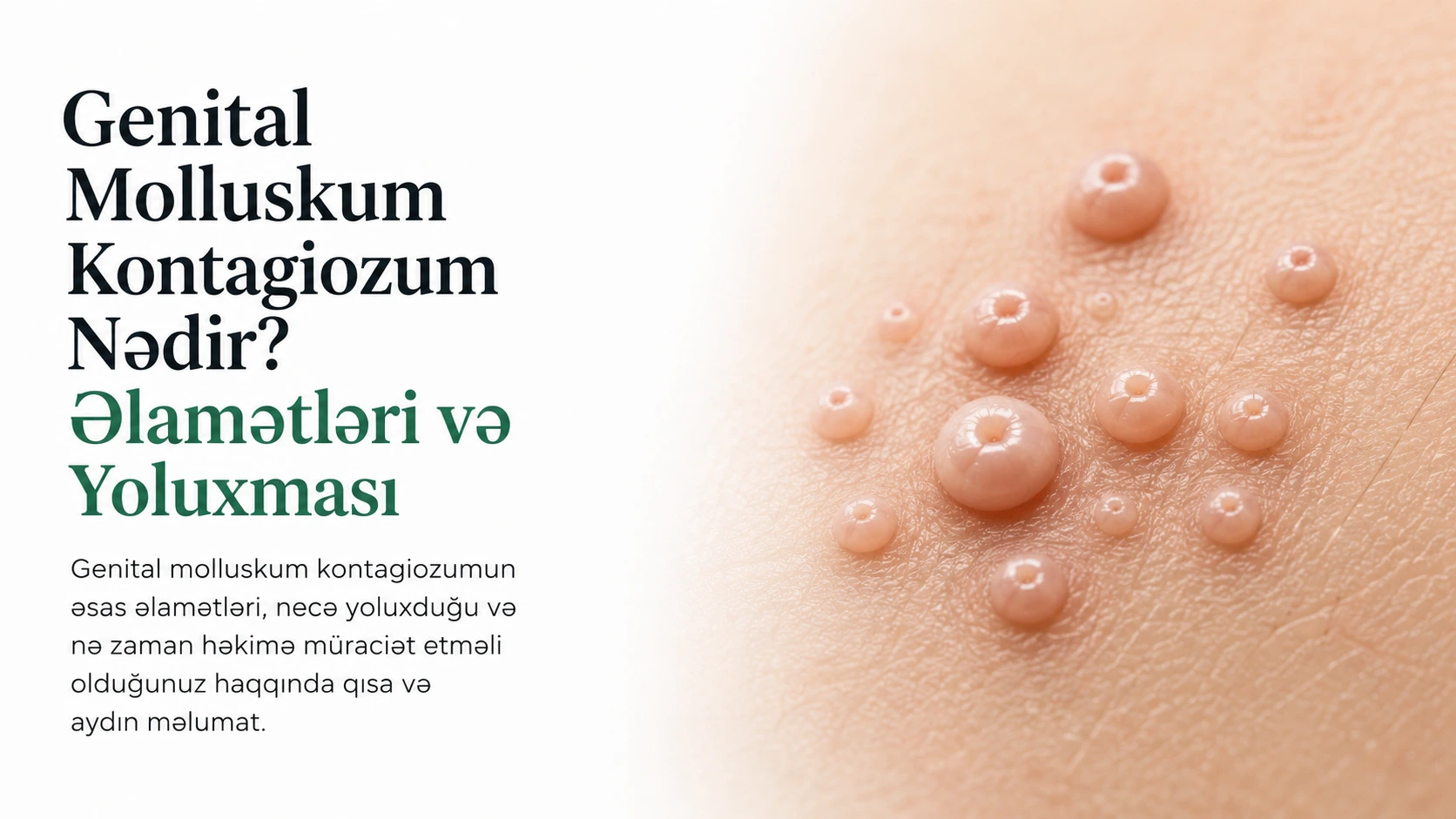 Genital Molluskum Kontagiozum Nədir? Əlamətləri və Yoluxması