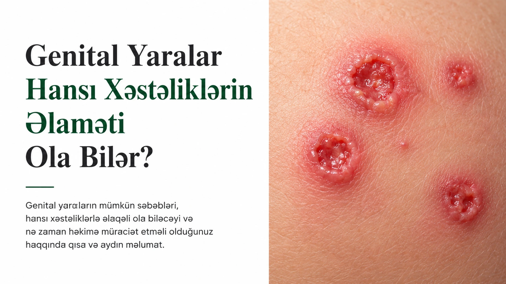 Genital Yaralar Hansı Xəstəliklərin Əlaməti Ola Bilər?