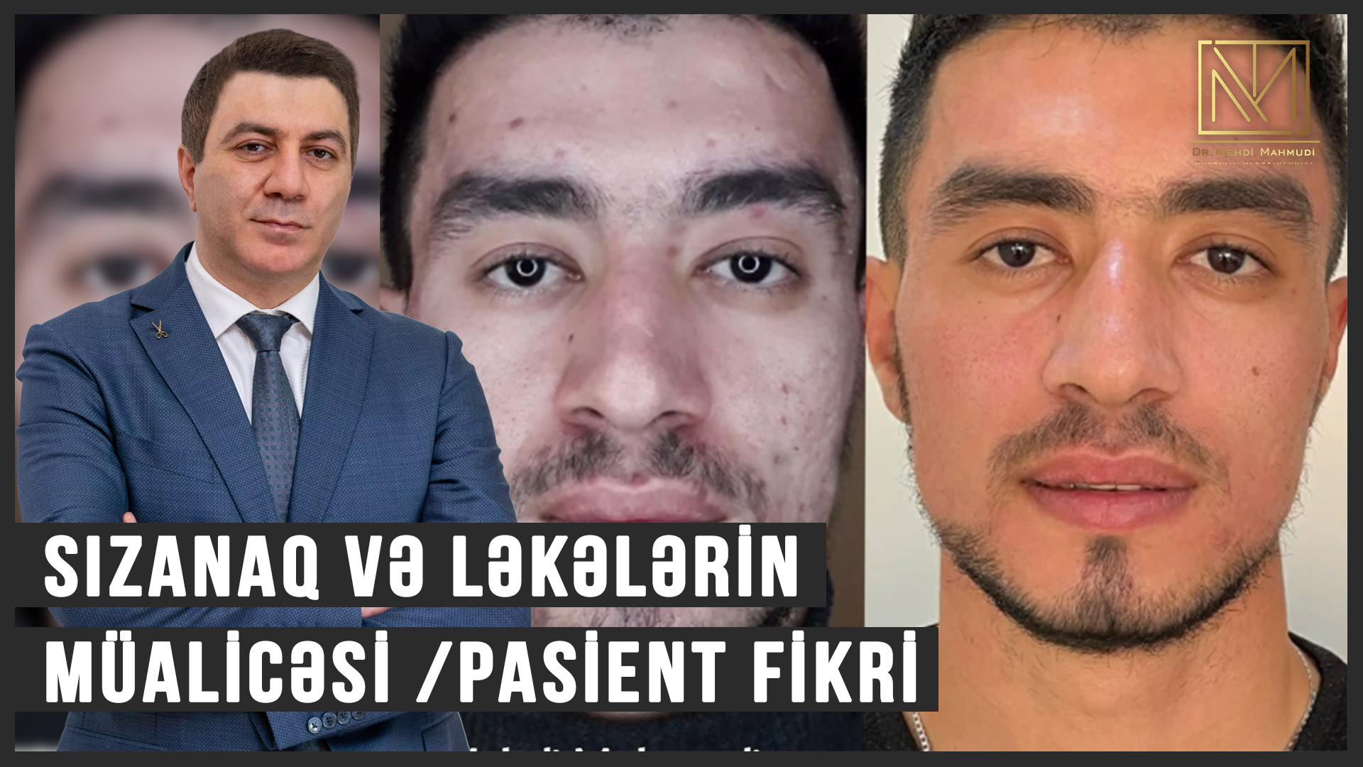 Sızanaq və ləkələrin müalicəsi /Pasient Fikri / Dermatoloq Hekim Dr Mehdi #2