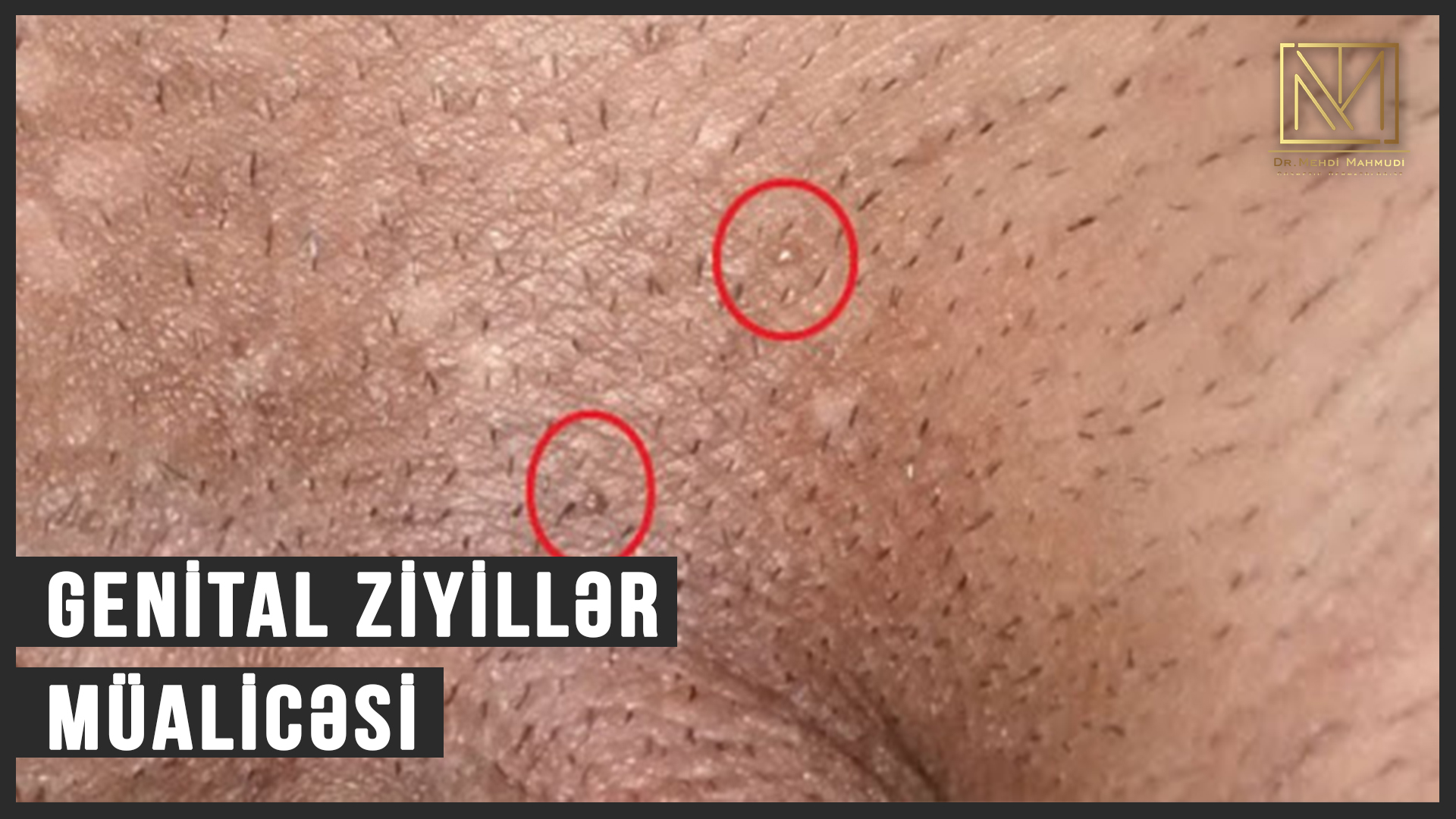 Genital Ziyillər (Genital Warts) - Dermatoloq Dr.Mehdi Mahmudi