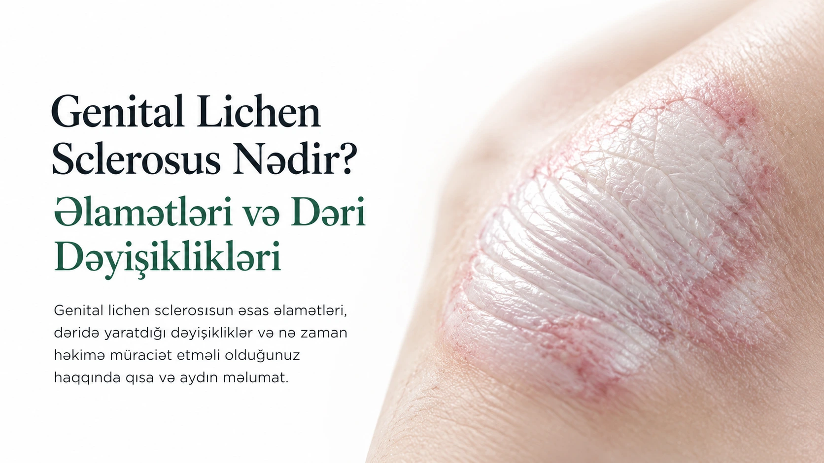 Genital Lichen Sclerosus Nədir? Əlamətləri və Dəri Dəyişiklikləri