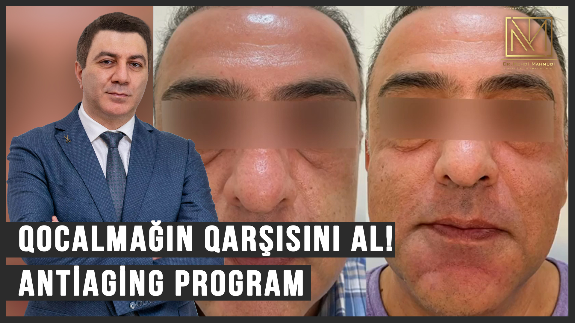 Qocalmağın Qarşısını Al! / Antiaging Program / Kosmetoloq Dermatoloq Dr Mehdi