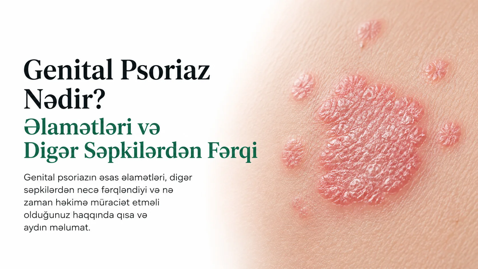 Genital Psoriaz Nədir? Əlamətləri və Digər Səpkilərdən Fərqi