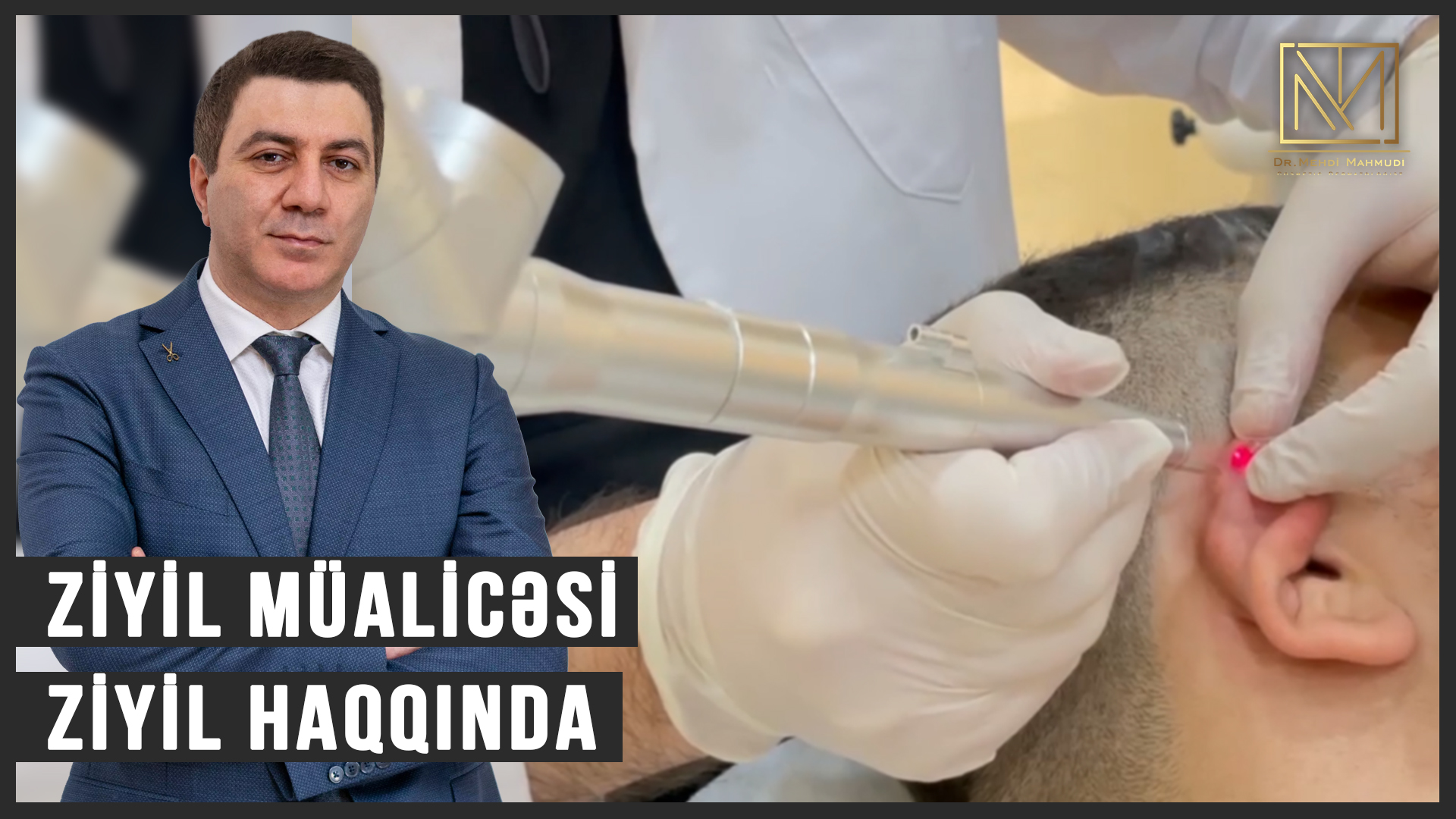 Dermatoloq Dr Mehdi / İnsan papilloma virusu / Ziyil Müalicəsi / Ziyil Haqqında