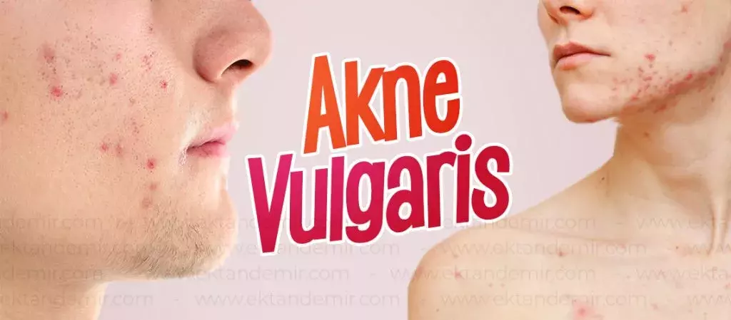 Akne və akne vulgaris arasındakı fərq nədir?