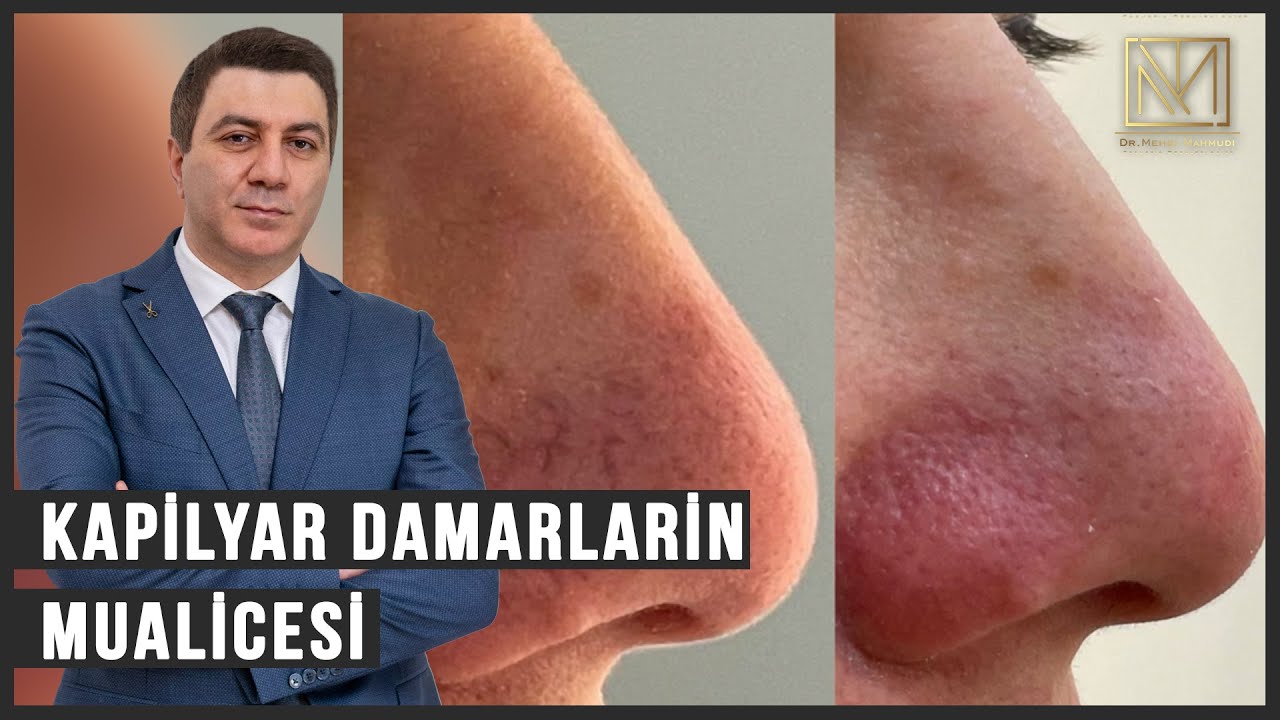 Kapilyarlar lazer vasitəsi ilə müalicəsi / Dermatoloq Həkim